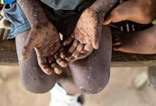 Monkeypox virus detected for the first time in the Netherlands
