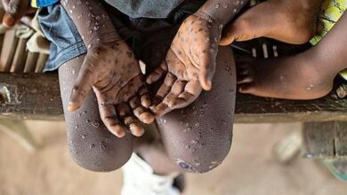 Monkeypox virus detected for the first time in the Netherlands