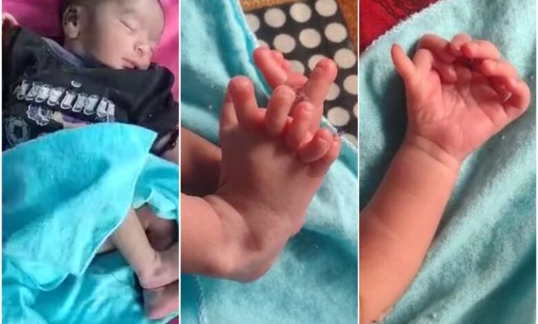 rajasthan rare baby girl born 14 fingers 12 toes4 650ab0c367178