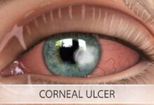 neoretina corneal ulcers 1200x900 1